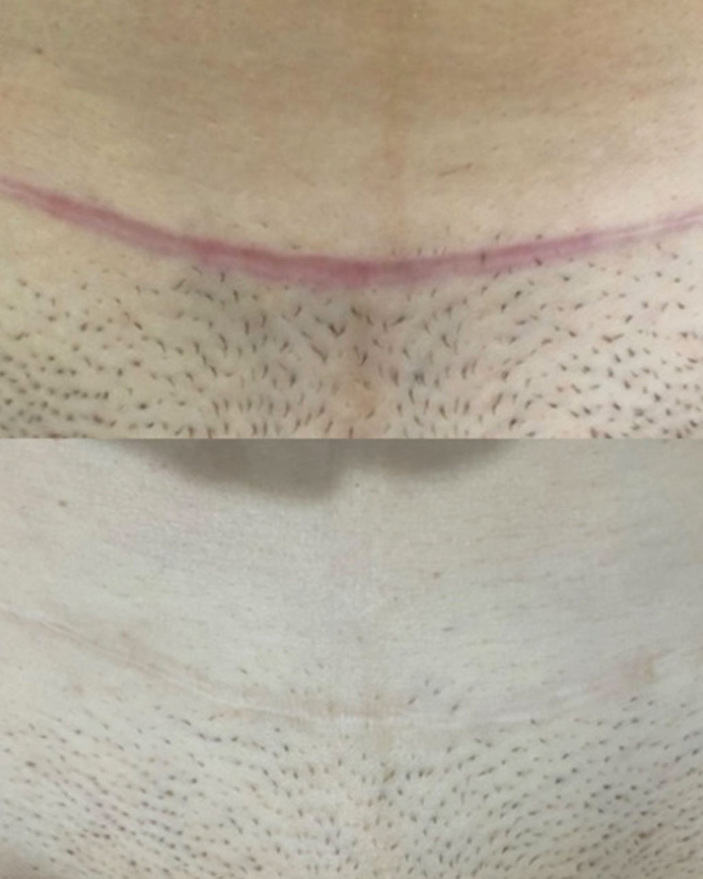 C-SECTION RECOVERY RESCUE (1x scar cream, 1x massage roller & 1x scar strip)