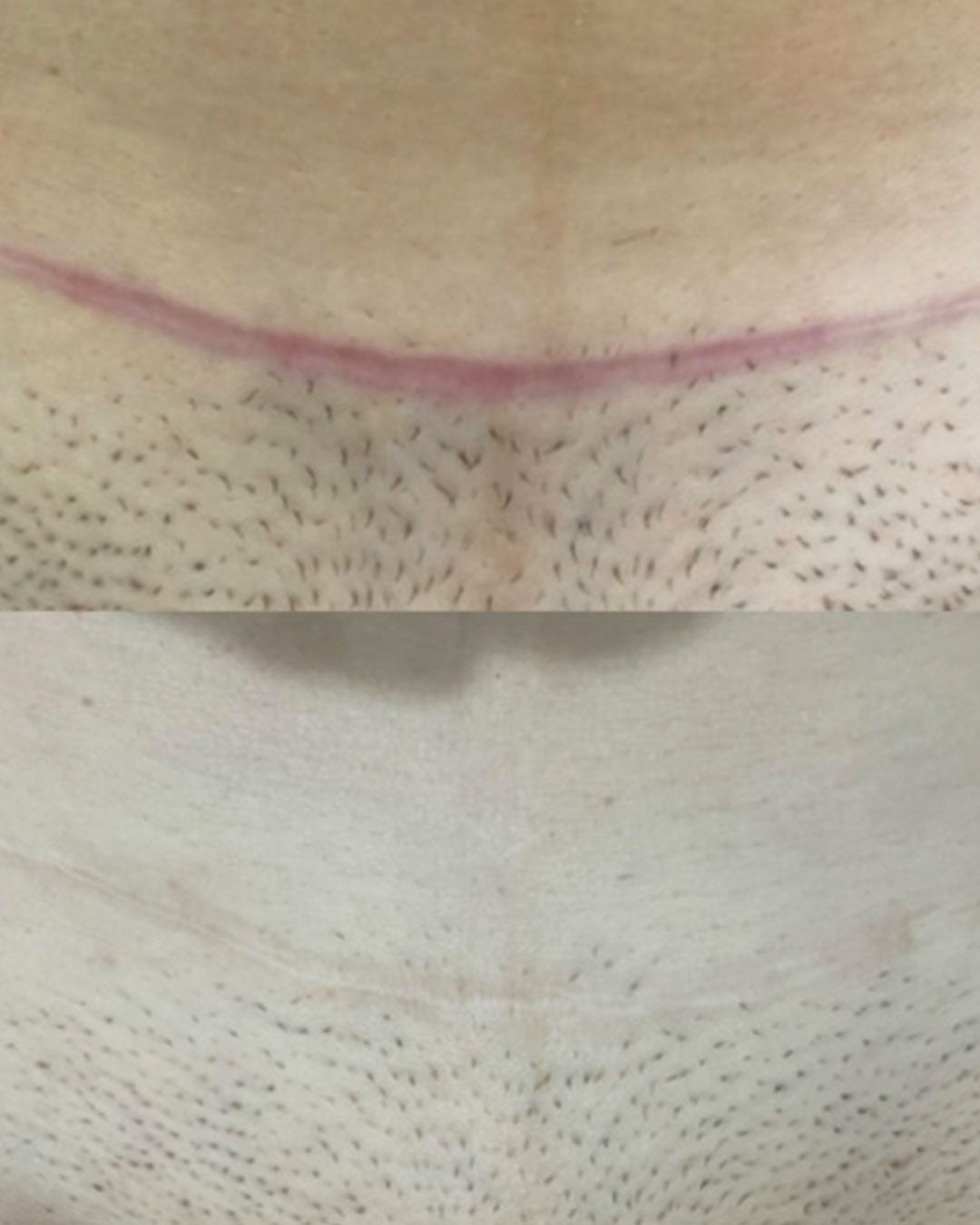 C-SECTION RECOVERY RESCUE (1x scar cream, 1x massage roller & 1x scar strip)